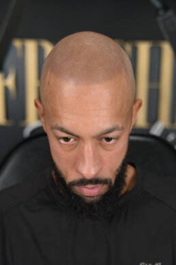 Fresher Studios healed scalp micropigmentation (SMP) result—front view with head tilted down, highlighting realistic density and a natural, blended hairline.