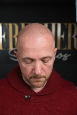 Fresher Studios healed scalp micro pigmentation (SMP) result—front portrait with head tilted down, showing a natural hairline and realistic density.