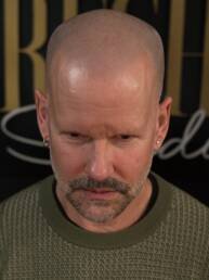 Healed scalp micropigmentation result—frontal portrait of a man with a natural-looking salt and pepper effect, demonstrating undetectable, artist-led SMP finish.