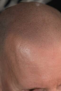 Fresher Studios healed scalp micro pigmentation (SMP) result—close-up of the frontal hairline showing precise follicle replication and a soft, natural transition.