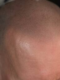 Healed scalp micropigmentation result—close-up view of the hairline and frontal scalp, showcasing natural salt and pepper effect with detailed follicle replication.