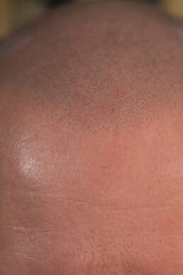 Fresher Studios healed scalp micro pigmentation (SMP) result—close-up of the frontal hairline showing precise follicle replication and a soft, natural transition.
