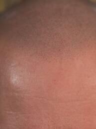 Close-up of healed scalp micropigmentation, highlighting the density and realism of salt and pepper pigment blending on the frontal scalp.