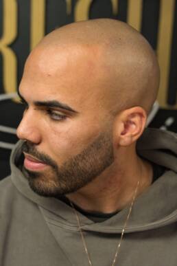 Fresher Studios healed scalp micro pigmentation (SMP) result—side profile showing clean hairline structure and consistent, natural-looking scalp coverage.