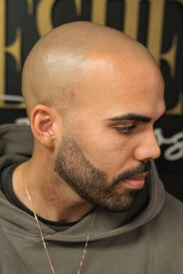 Fresher Studios healed scalp micro pigmentation (SMP) result—side profile highlighting a natural hairline edge and realistic density.