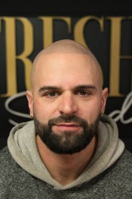 Fresher Studios healed scalp micro pigmentation (SMP) result—front portrait showing a natural hairline and realistic, even density.