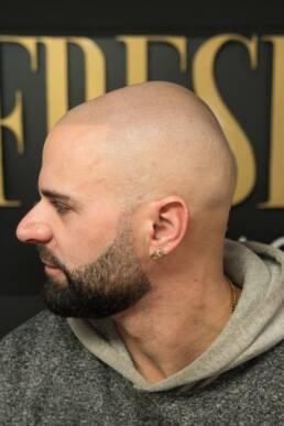Fresher Studios healed scalp micro pigmentation (SMP) result—left-side profile highlighting a soft, natural hairline transition and consistent density.