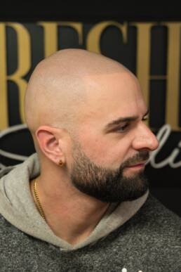 Fresher Studios healed scalp micro pigmentation (SMP) result—right-side profile showing natural-looking scalp coverage and a clean, balanced hairline.