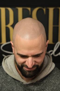 Fresher Studios healed scalp micro pigmentation (SMP) result—front view with head tilted down, highlighting a clean, natural hairline and consistent density. Barbers Edge UP Hairline