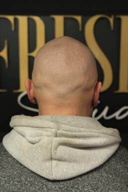 Fresher Studios healed scalp micro pigmentation (SMP) result—back view showing even coverage and natural density across the crown.